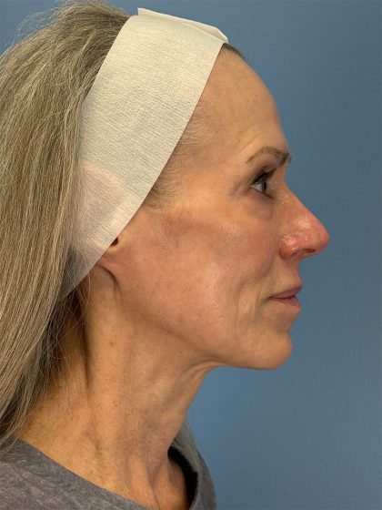 CO2 Laser Before & After Patient #16417