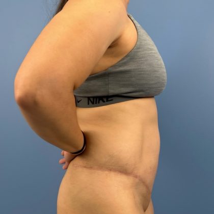 Tummy Tuck Before & After Patient #16339