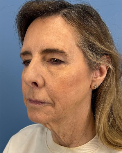 CO2 Laser Before & After Patient #16399