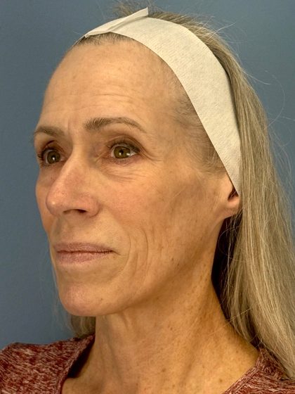 CO2 Laser Before & After Patient #16417