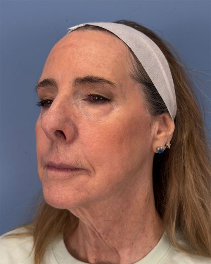 CO2 Laser Before & After Patient #16399