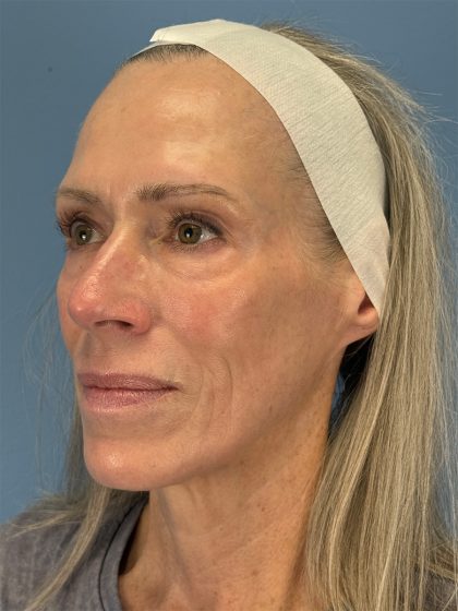 CO2 Laser Before & After Patient #16417