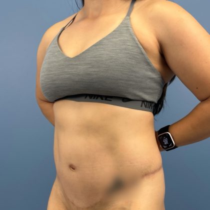 Tummy Tuck Before & After Patient #16339