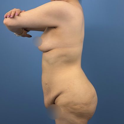 Breast Augmentation Before & After Patient #16361