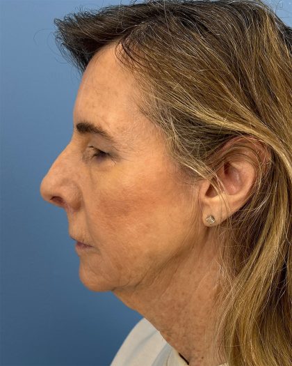 CO2 Laser Before & After Patient #16399