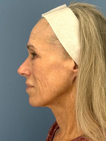 CO2 Laser Before & After Patient #16417