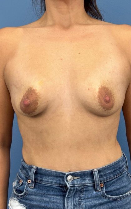 Breast Augmentation Before & After Patient #16350