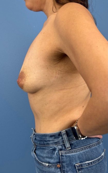 Breast Augmentation Before & After Patient #16350