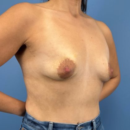 Breast Augmentation Before & After Patient #16350