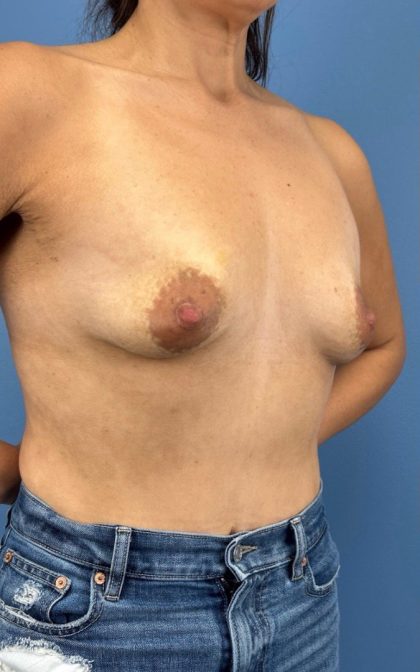 Breast Augmentation Before & After Patient #16350