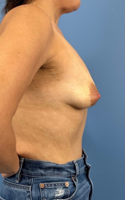 Breast Augmentation Before & After Patient #16350