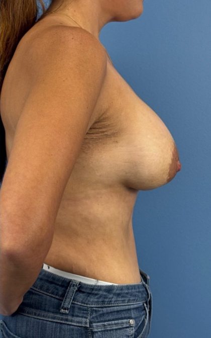 Breast Augmentation Before & After Patient #16350