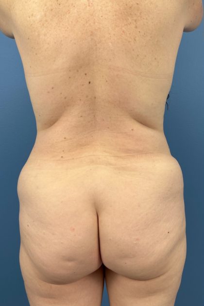 Lower Body Lift Before & After Patient #16641