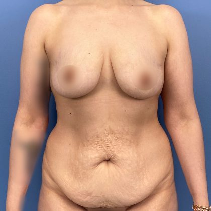 Tummy Tuck Before & After Patient #16555