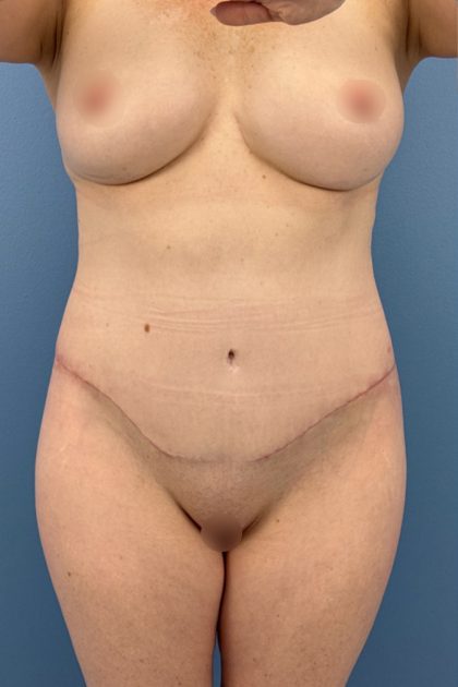 Lower Body Lift Before & After Patient #16641