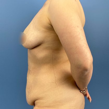 Tummy Tuck Before & After Patient #16555
