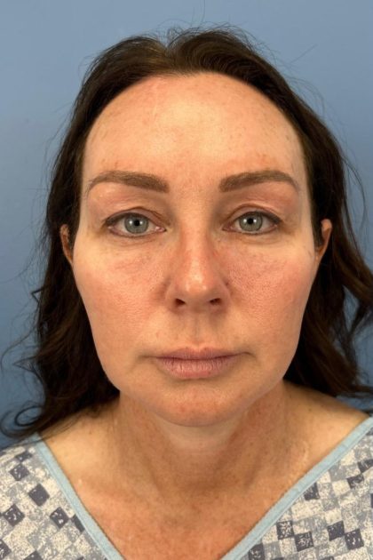 Browlift Before & After Patient #16630