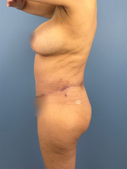 Tummy Tuck Before & After Patient #16501
