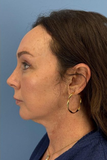 Browlift Before & After Patient #16630