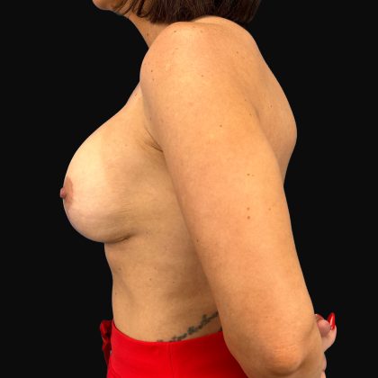 Breast Lift/Mastopexy Before & After Patient #16439