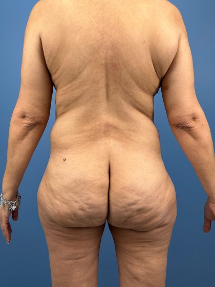 Tummy Tuck Before & After Patient #16501