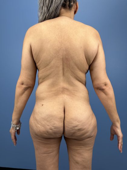 Lower Body Lift Before & After Patient #16501