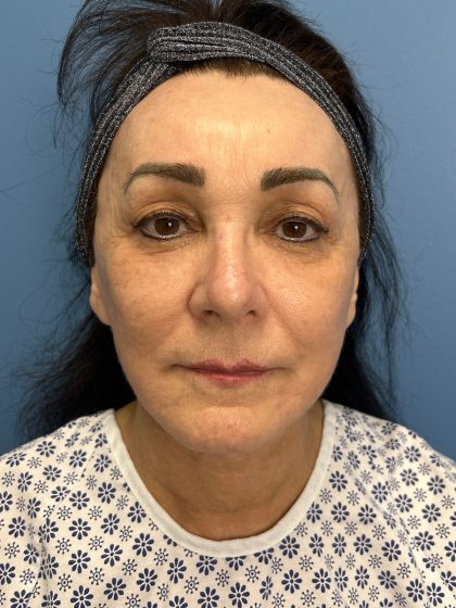 Browlift Before & After Patient #16464