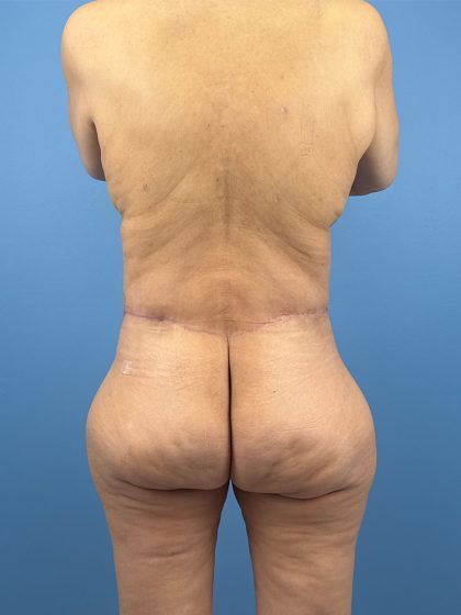 Tummy Tuck Before & After Patient #16501