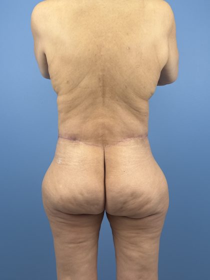 Lower Body Lift Before & After Patient #16501