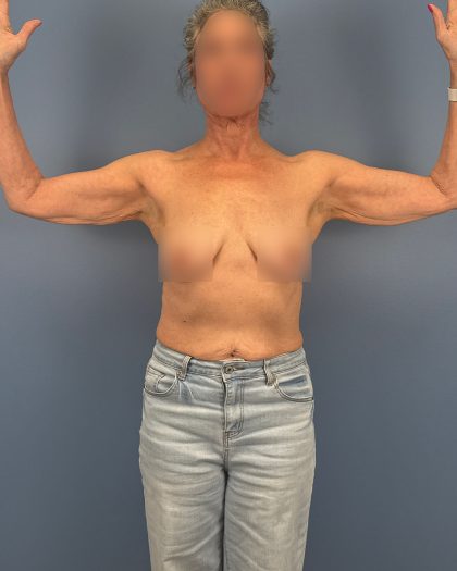 Arm Lift Before & After Patient #16492