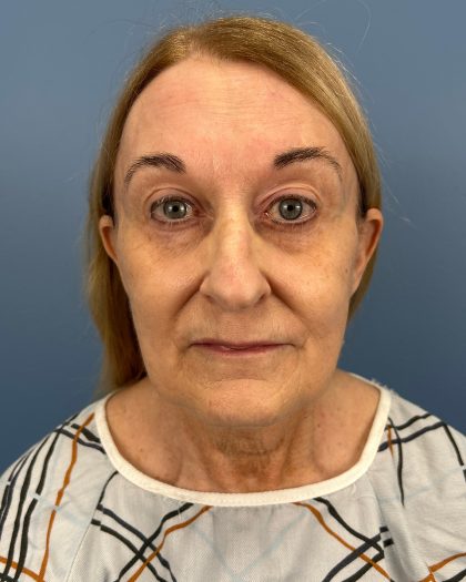 Facelift and Necklift Before & After Patient #16514