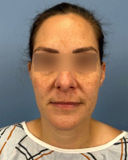 Rhinoplasty Before & After Patient #16563
