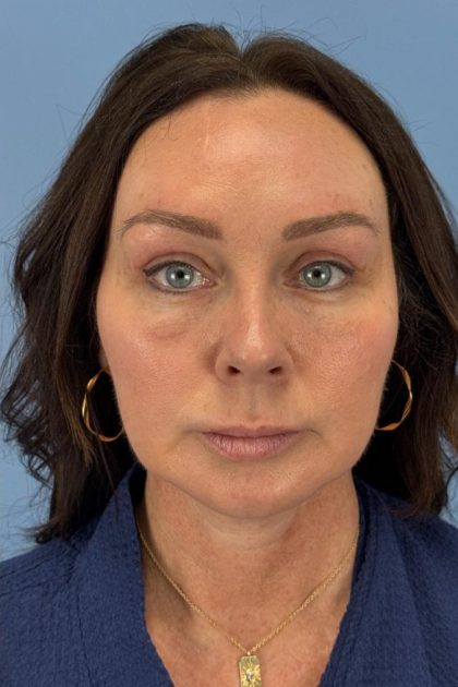Browlift Before & After Patient #16630