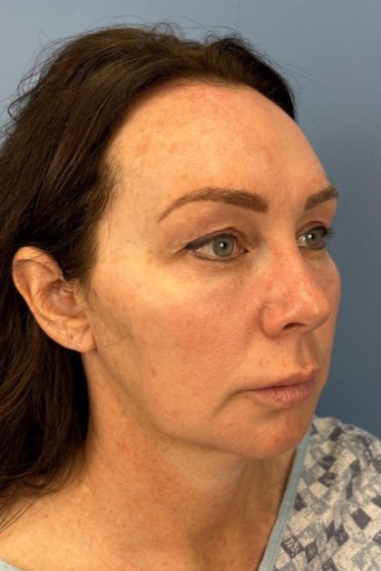 Browlift Before & After Patient #16630