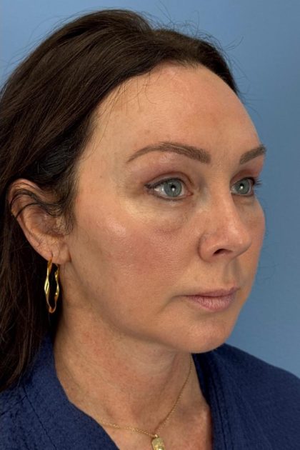 Browlift Before & After Patient #16630
