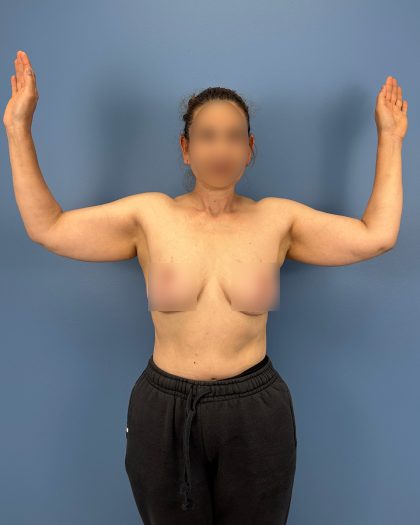 Arm Lift Before & After Patient #16428