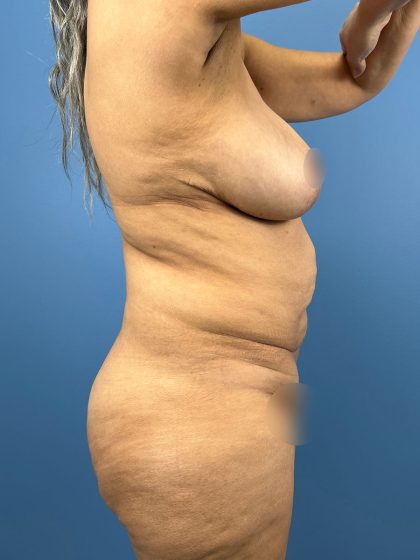 Tummy Tuck Before & After Patient #16501