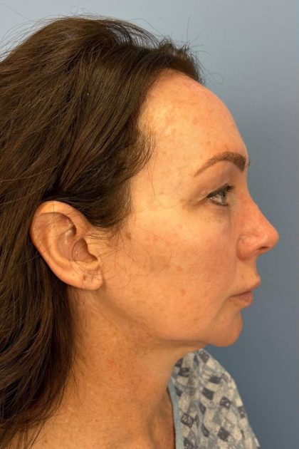 Browlift Before & After Patient #16630