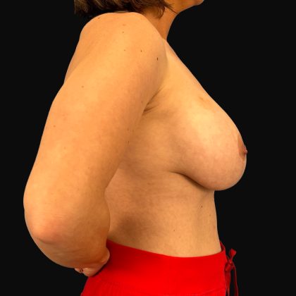 Breast Lift/Mastopexy Before & After Patient #16439