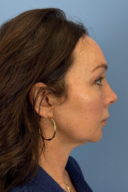 Browlift Before & After Patient #16630