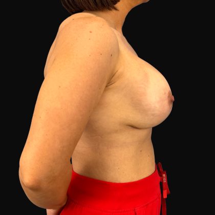 Breast Lift/Mastopexy Before & After Patient #16439