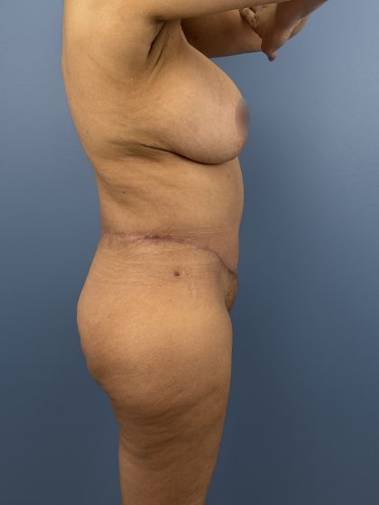 Lower Body Lift Before & After Patient #16501