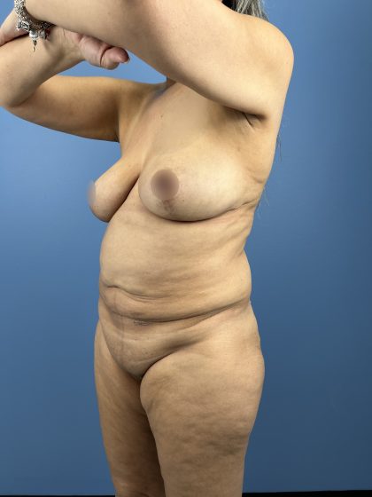 Lower Body Lift Before & After Patient #16501