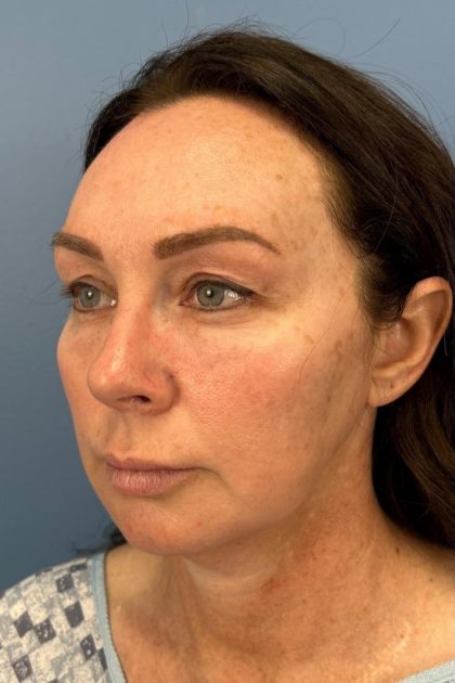 Browlift Before & After Patient #16630