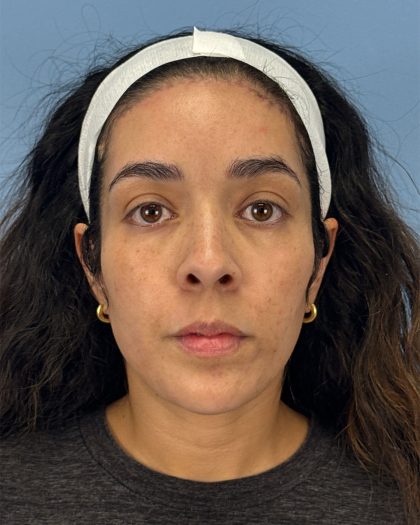 Browlift Before & After Patient #16455