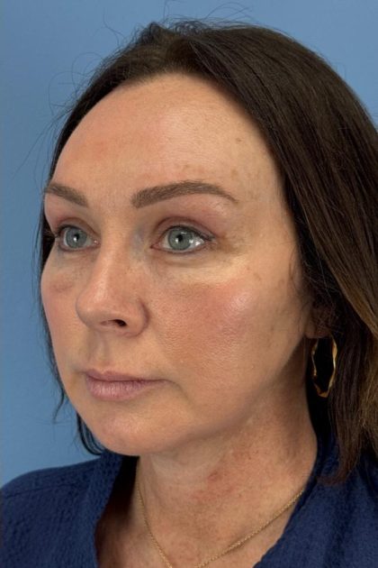 Browlift Before & After Patient #16630