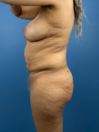 Tummy Tuck Before & After Patient #16501