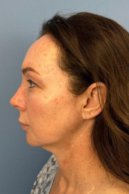 Browlift Before & After Patient #16630