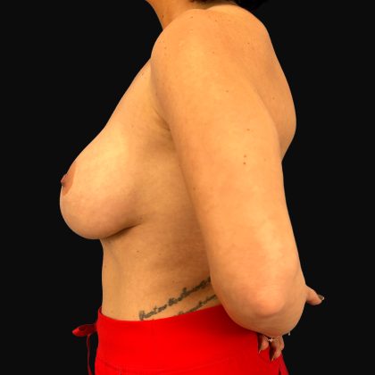 Breast Lift/Mastopexy Before & After Patient #16439
