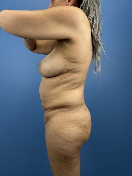 Lower Body Lift Before & After Patient #16501